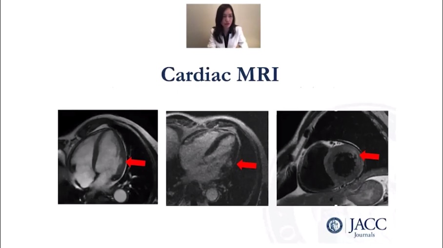 JACC: Early Immune Checkpoint Inhibitor Cardiotoxicity CardioOncology Video Case Presentation